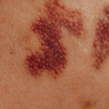 Close-up of irritated skin caused by bleaching products