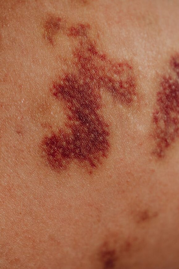 Close-up of irritated skin caused by bleaching products