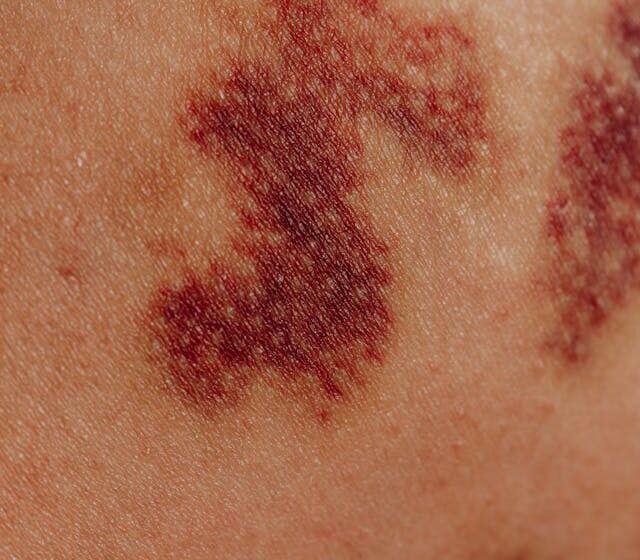 Close-up of irritated skin caused by bleaching products